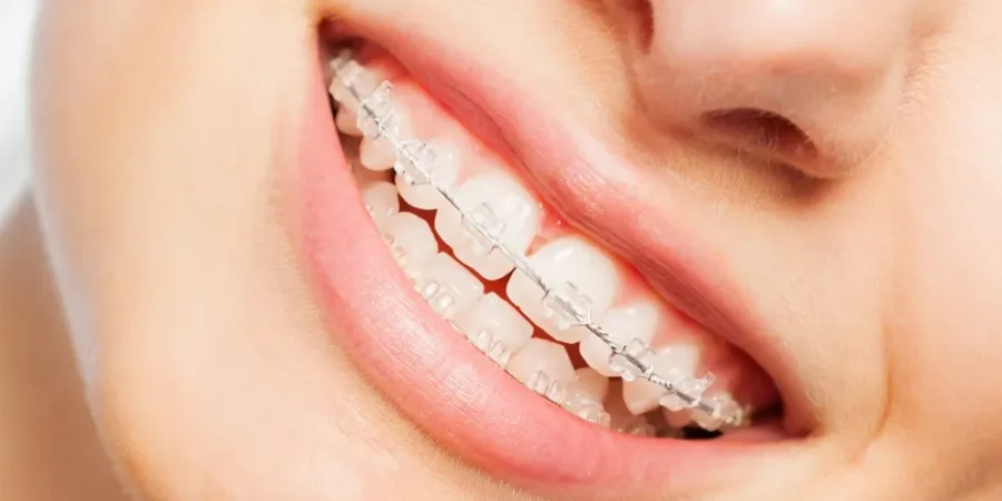 Clear Braces