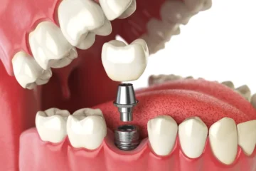 Dental Implants