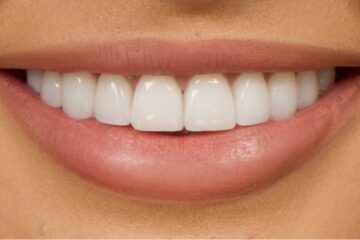 Veneers